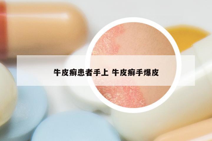 牛皮癣患者手上 牛皮癣手爆皮
