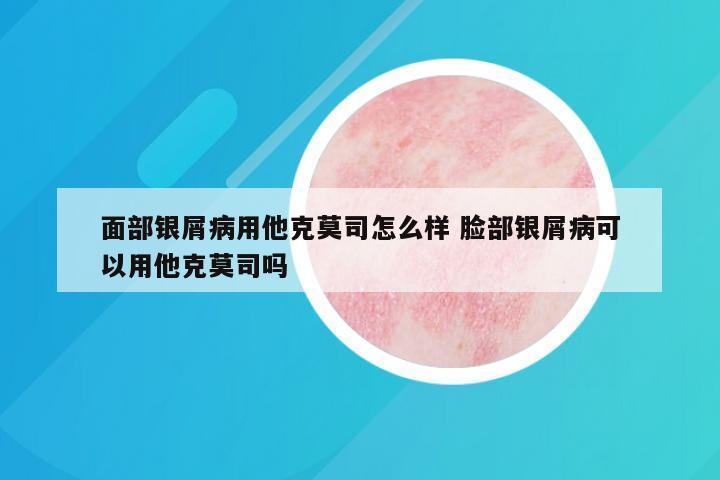 面部银屑病用他克莫司怎么样 脸部银屑病可以用他克莫司吗