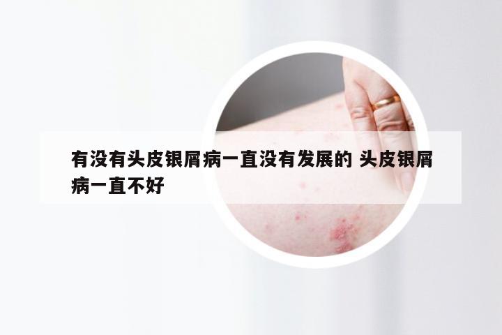 有没有头皮银屑病一直没有发展的 头皮银屑病一直不好