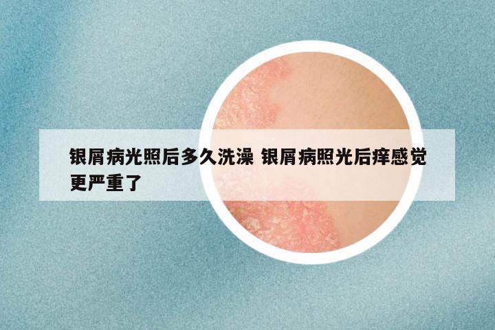 银屑病光照后多久洗澡 银屑病照光后痒感觉更严重了
