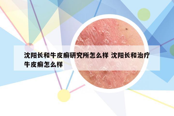 沈阳长和牛皮癣研究所怎么样 沈阳长和治疗牛皮癣怎么样