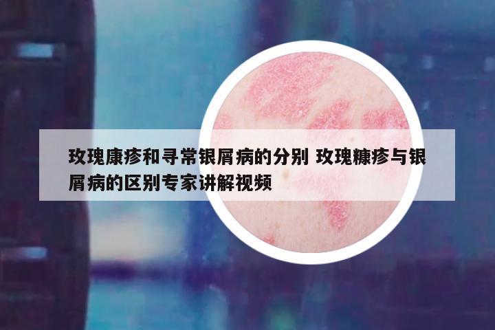 玫瑰康疹和寻常银屑病的分别 玫瑰糠疹与银屑病的区别专家讲解视频