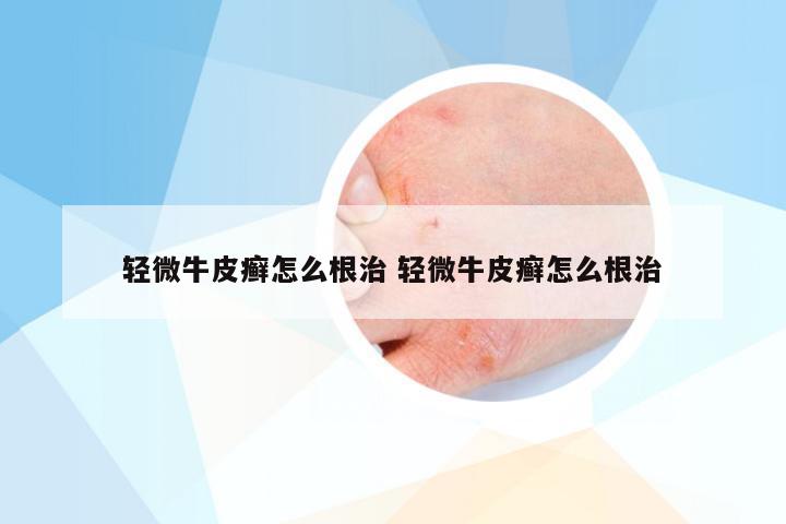 轻微牛皮癣怎么根治 轻微牛皮癣怎么根治