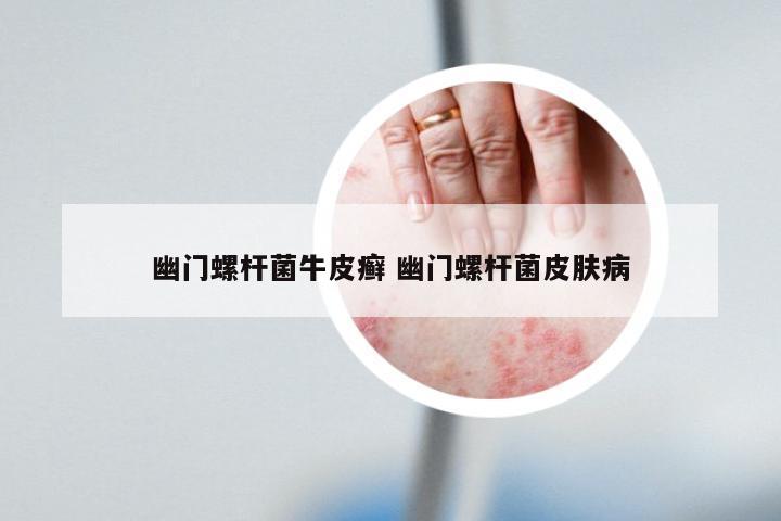 幽门螺杆菌牛皮癣 幽门螺杆菌皮肤病