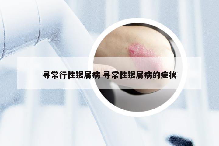 寻常行性银屑病 寻常性银屑病的症状