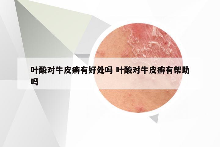叶酸对牛皮癣有好处吗 叶酸对牛皮癣有帮助吗