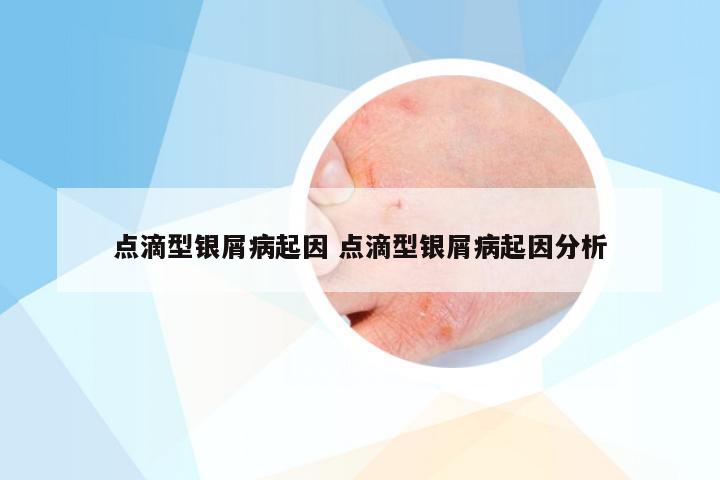 点滴型银屑病起因 点滴型银屑病起因分析