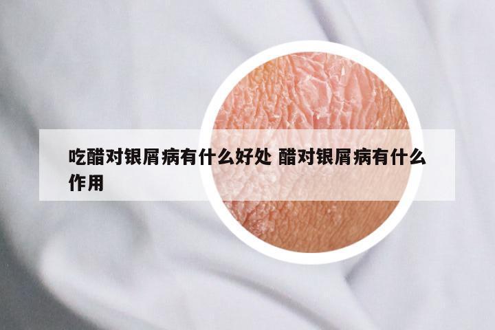 吃醋对银屑病有什么好处 醋对银屑病有什么作用