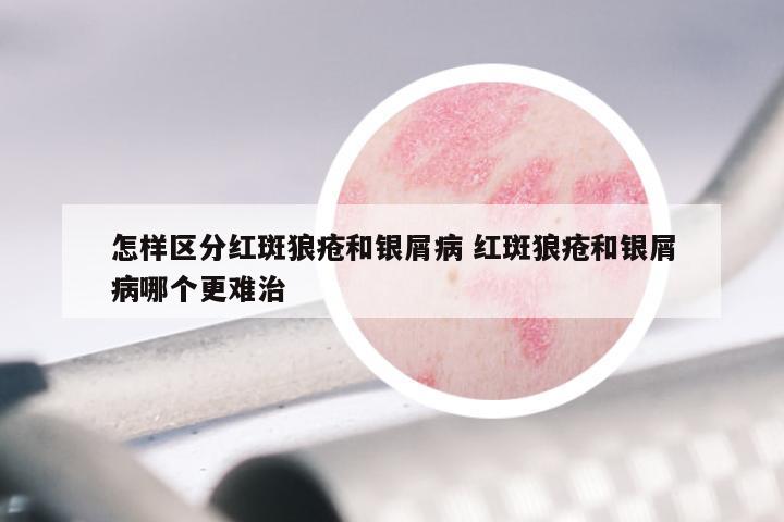 怎样区分红斑狼疮和银屑病 红斑狼疮和银屑病哪个更难治