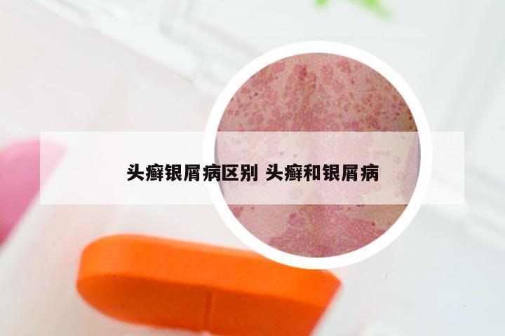头癣银屑病区别 头癣和银屑病