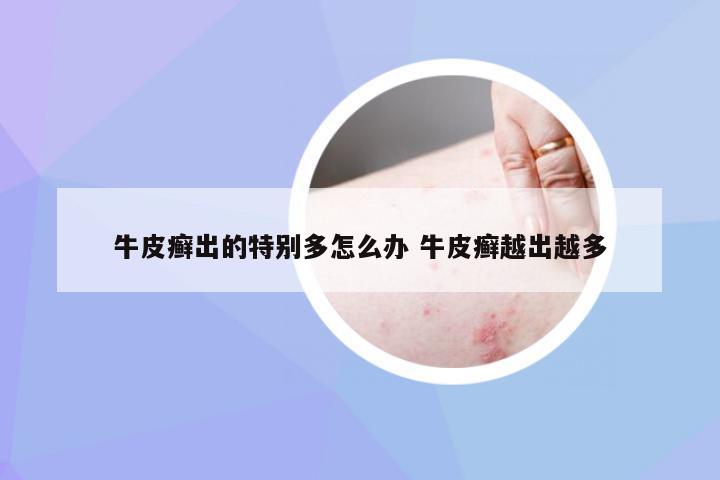 牛皮癣出的特别多怎么办 牛皮癣越出越多