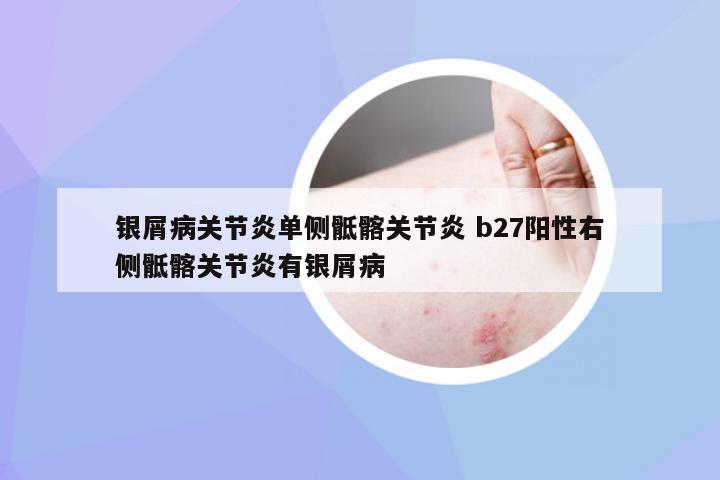 银屑病关节炎单侧骶髂关节炎 b27阳性右侧骶髂关节炎有银屑病
