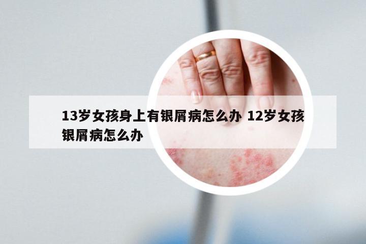 13岁女孩身上有银屑病怎么办 12岁女孩银屑病怎么办
