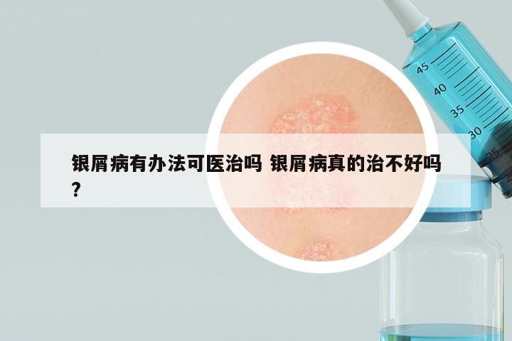 银屑病有办法可医治吗 银屑病真的治不好吗?