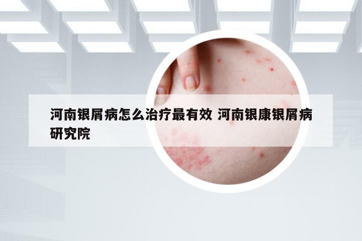 河南银屑病怎么治疗最有效 河南银康银屑病研究院