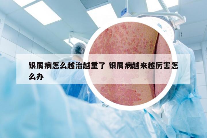银屑病怎么越治越重了 银屑病越来越厉害怎么办