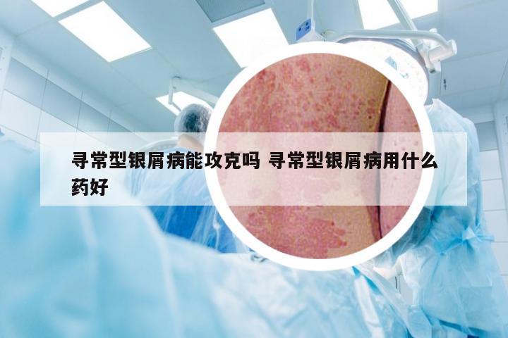 寻常型银屑病能攻克吗 寻常型银屑病用什么药好