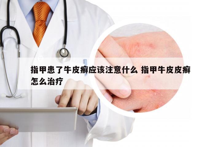 指甲患了牛皮癣应该注意什么 指甲牛皮皮癣怎么治疗