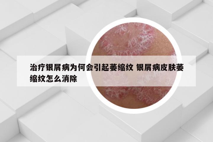 治疗银屑病为何会引起萎缩纹 银屑病皮肤萎缩纹怎么消除