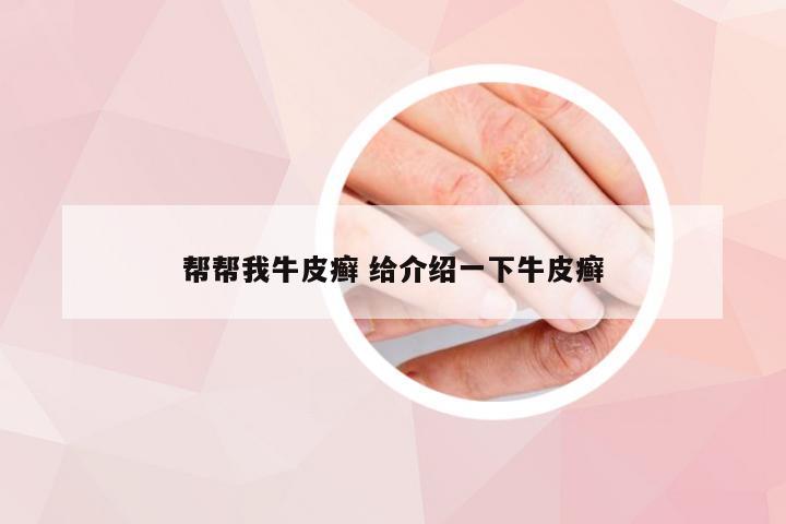 帮帮我牛皮癣 给介绍一下牛皮癣