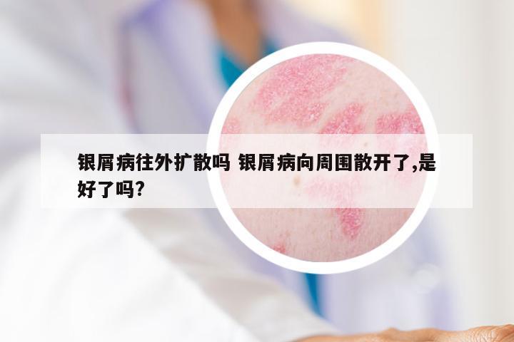 银屑病往外扩散吗 银屑病向周围散开了,是好了吗?