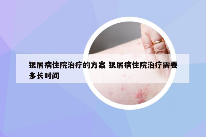 银屑病住院治疗的方案 银屑病住院治疗需要多长时间