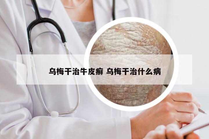 乌梅干治牛皮癣 乌梅干治什么病