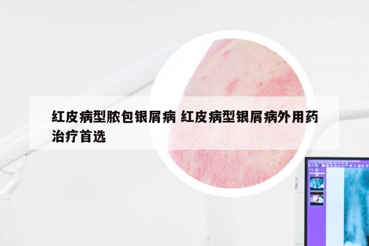 红皮病型脓包银屑病 红皮病型银屑病外用药治疗首选