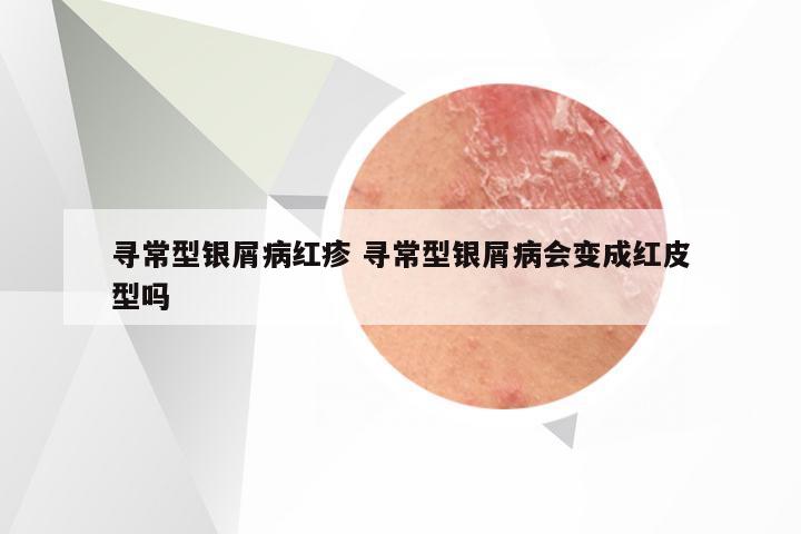 寻常型银屑病红疹 寻常型银屑病会变成红皮型吗