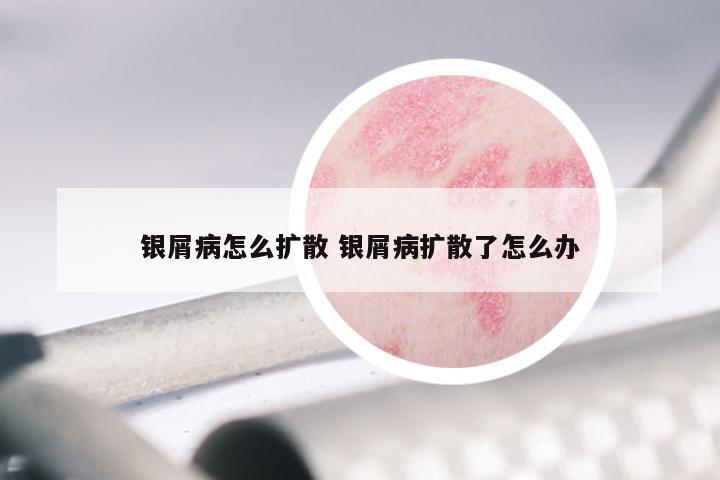 银屑病怎么扩散 银屑病扩散了怎么办