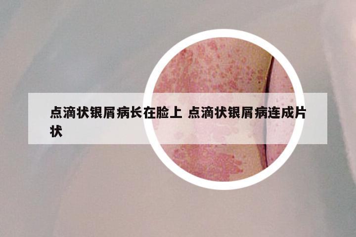 点滴状银屑病长在脸上 点滴状银屑病连成片状