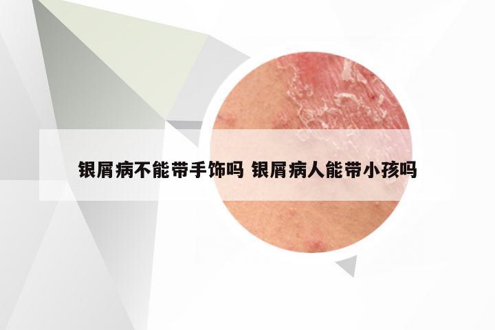 银屑病不能带手饰吗 银屑病人能带小孩吗