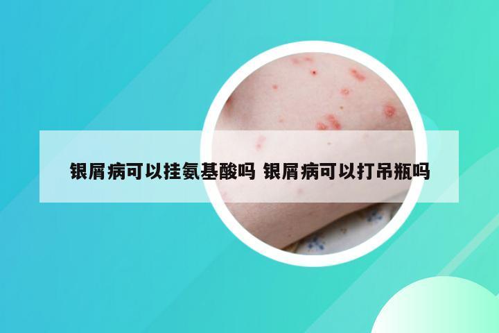 银屑病可以挂氨基酸吗 银屑病可以打吊瓶吗