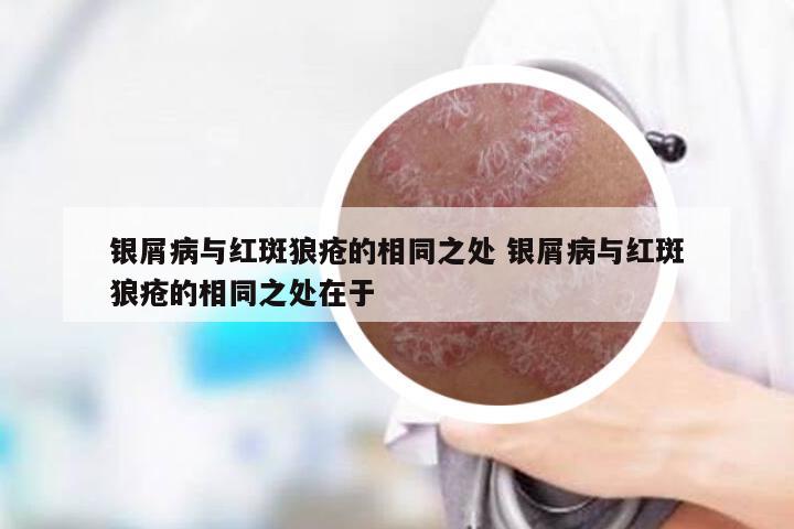 银屑病与红斑狼疮的相同之处 银屑病与红斑狼疮的相同之处在于