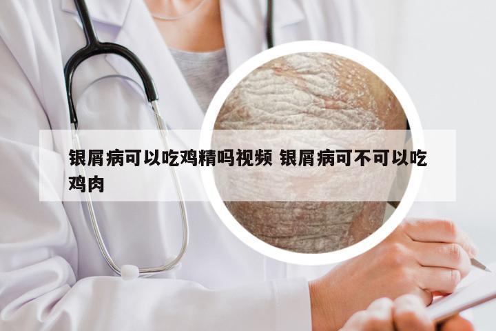 银屑病可以吃鸡精吗视频 银屑病可不可以吃鸡肉