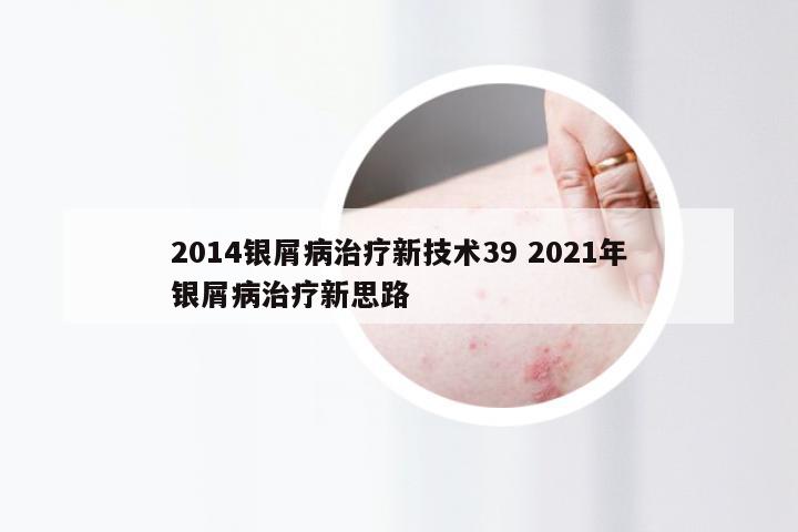 2014银屑病治疗新技术39 2021年银屑病治疗新思路