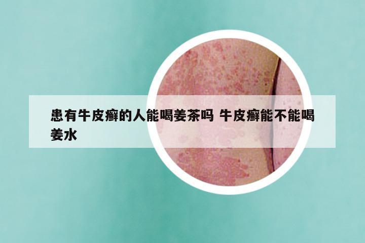 患有牛皮癣的人能喝姜茶吗 牛皮癣能不能喝姜水