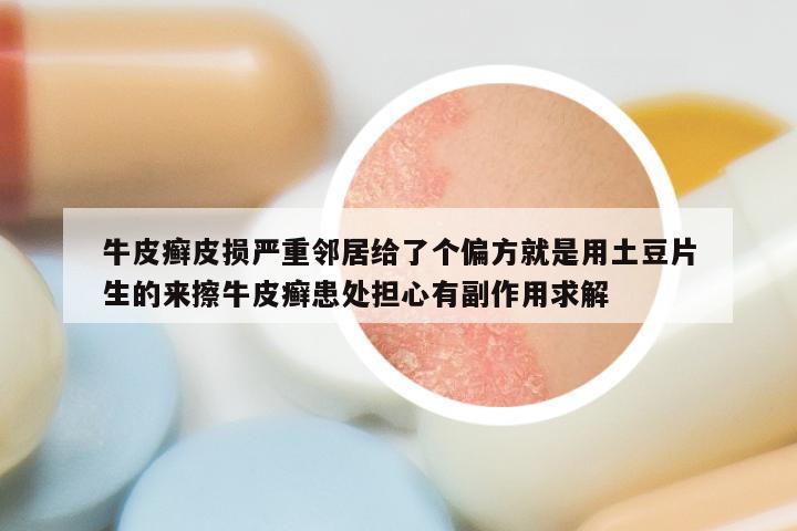 牛皮癣皮损严重邻居给了个偏方就是用土豆片生的来擦牛皮癣患处担心有副作用求解