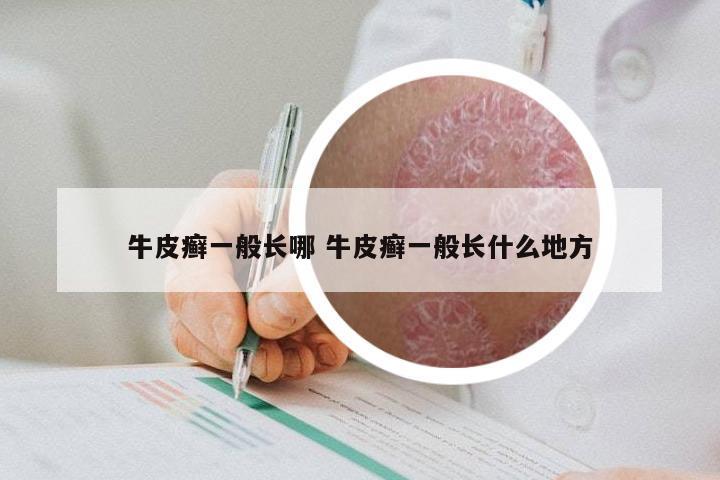 牛皮癣一般长哪 牛皮癣一般长什么地方