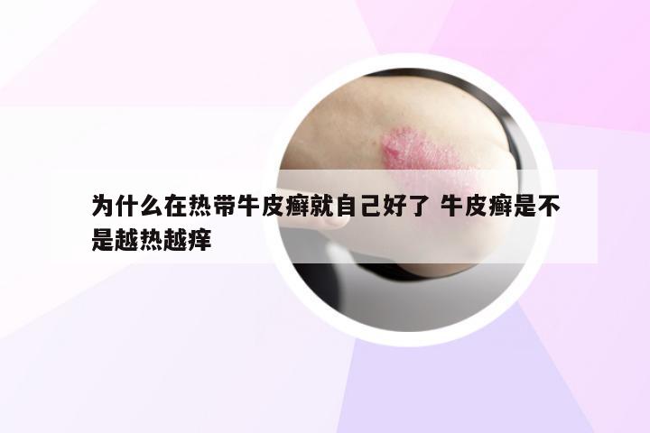 为什么在热带牛皮癣就自己好了 牛皮癣是不是越热越痒
