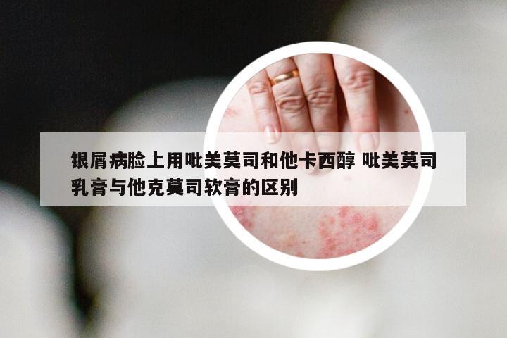 银屑病脸上用吡美莫司和他卡西醇 吡美莫司乳膏与他克莫司软膏的区别