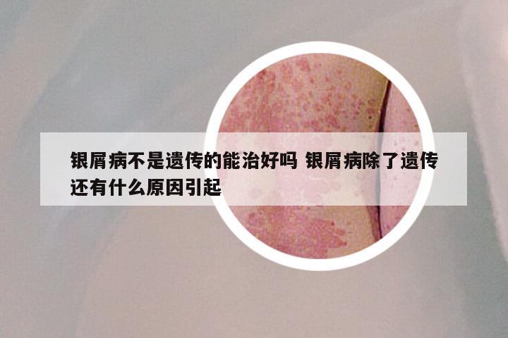 银屑病不是遗传的能治好吗 银屑病除了遗传还有什么原因引起