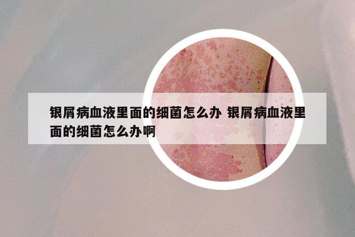 银屑病血液里面的细菌怎么办 银屑病血液里面的细菌怎么办啊
