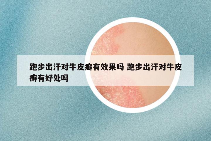 跑步出汗对牛皮癣有效果吗 跑步出汗对牛皮癣有好处吗