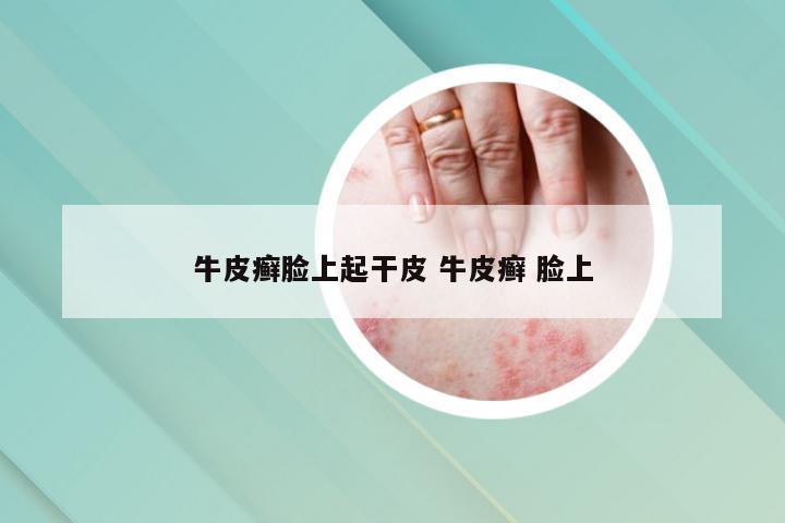 牛皮癣脸上起干皮 牛皮癣 脸上