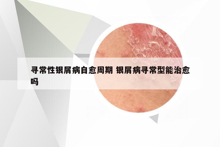 寻常性银屑病自愈周期 银屑病寻常型能治愈吗