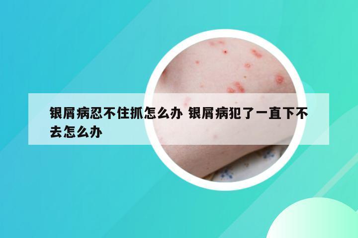 银屑病忍不住抓怎么办 银屑病犯了一直下不去怎么办