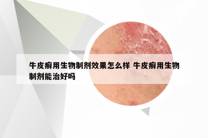 牛皮癣用生物制剂效果怎么样 牛皮癣用生物制剂能治好吗