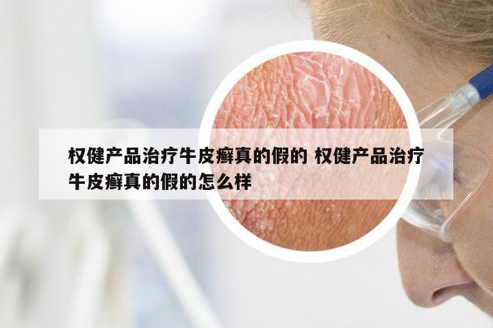 权健产品治疗牛皮癣真的假的 权健产品治疗牛皮癣真的假的怎么样