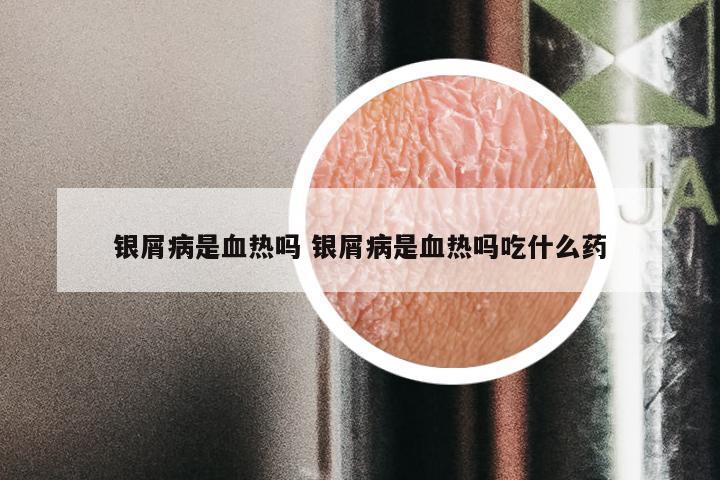 银屑病是血热吗 银屑病是血热吗吃什么药